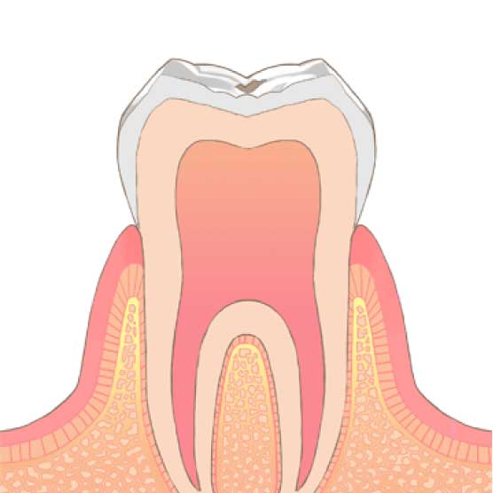 虫歯の進行度1(C0)の歯の状態